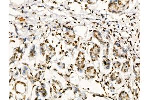 Phospho-Foxp3 (Ser19) Antibody at 1/100 staining Human pancreatic cancer by IHC-P.