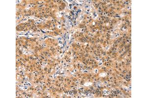 Immunohistochemistry of Human gastric cancer using EIF4G1 Polyclonal Antibody at dilution of 1:30 (EIF4G1 anticorps)