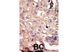 Formalin-fixed and paraffin-embedded human cancer tissue reacted with the primary antibody, which was peroxidase-conjugated to the secondary antibody, followed by AEC staining.