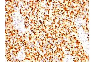Formalin-fixed, paraffin-embedded human Rhabdomyosarcoma stained with Myogenin Mouse Monoclonal Antibody (SPM144) (Myogenin anticorps)