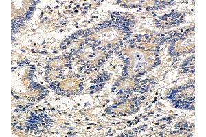 ABIN6260104 and ABIN6278139 at 1/100 staining human colorectal cancer by IHC-P. (ATG4A anticorps  (N-Term))