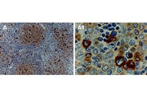 Formalin-fixed, paraffin-embedded human lymphoma tissue section stained for TRAF1 expression.