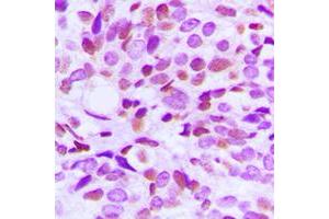 Immunohistochemical analysis of BRAF35 staining in human breast cancer formalin fixed paraffin embedded tissue section.