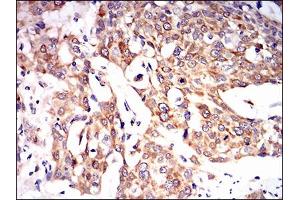 Immunohistochemical analysis of paraffin-embedded esophageal cancer tissues using PON1 mouse mAb with DAB staining.