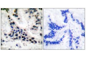 Immunohistochemical analysis of paraffin-embedded human lung carcinoma tissue, using HDAC1 antibody (ABIN5976420). (HDAC1 anticorps  (C-Term))