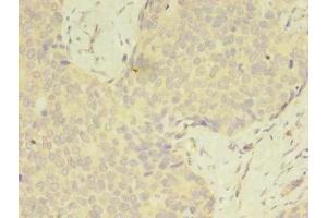 Immunohistochemistry of paraffin-embedded human gastric cancer using ABIN7175049 at dilution of 1:100 (C2ORF69 anticorps  (AA 117-269))