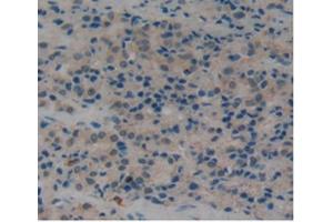 IHC-P analysis of Human Prostate Gland Cancer Tissue, with DAB staining. (PLAT anticorps  (AA 311-562))