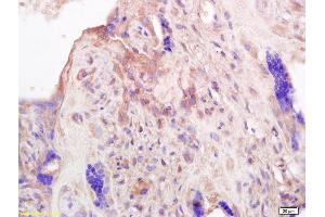 Formalin-fixed and paraffin embedded human placenta labeled with Anti-PRL Polyclonal Antibody, Unconjugated (ABIN669456) at 1:200 followed by conjugation to the secondary antibody and DAB staining.