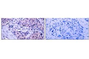 Immunohistochemical analysis of paraffin- embedded human breast carcinoma tissue using PDK1 (Ab-241) antibody (E021005). (PDPK1 anticorps)