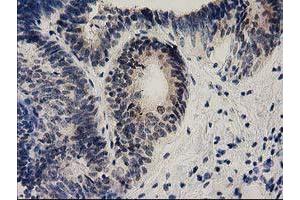Immunohistochemical staining of paraffin-embedded Adenocarcinoma of Human endometrium tissue using anti-EFNA2 mouse monoclonal antibody. (Ephrin A2 anticorps)