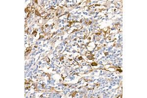 Immunohistochemistry of paraffin-embedded Human Hodgkin lymphoma (positive control antibody staining, clone 55k-2) using Fascin/FSCN1 antibody (ABIN7267142) at dilution of 1:100 (40x lens). (Fascin anticorps)