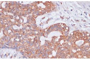 Immunohistochemistry of paraffin-embedded Human breast cancer using KCNH2 Polyclonal Antibody at dilution of 1:100 (40x lens).