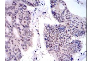 Immunohistochemical analysis of paraffin-embedded colon cancer tissues using KID mouse mAb with DAB staining.