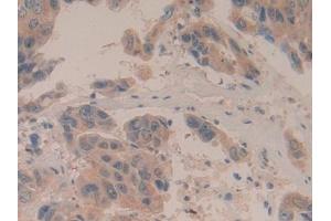 Detection of BAD in Human Breast cancer Tissue using Polyclonal Antibody to Bcl2 Associated Death Promoter (BAD)