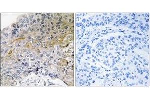 Immunohistochemistry analysis of paraffin-embedded human breast carcinoma tissue, using p130 Cas (Ab-410) Antibody. (BCAR1 anticorps  (AA 376-425))