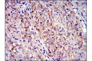 Immunohistochemical analysis of paraffin-embedded gastrointestinal stromal tumor using KIT mouse mAb with DAB staining. (KIT anticorps)