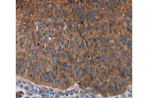 Immunohistochemistry of Human lung cancer using JUP Polyclonal Antibody at dilution of 1:50 (JUP anticorps)