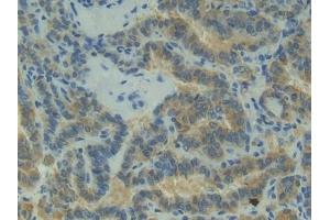 Detection of P-cadherin in Human Thyroid cancer Tissue using Polyclonal Antibody to Placental Cadherin (P-cadherin)