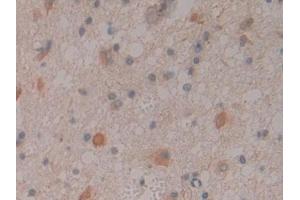 DAB staining on IHC-P; Samples: Human Glioma Tissue