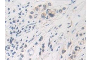 Detection of FDFT1 in Human Stomach cancer Tissue using Polyclonal Antibody to Farnesyl Diphosphate Farnesyltransferase 1 (FDFT1)