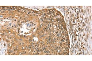 Immunohistochemistry of paraffin-embedded Human esophagus cancer using MORF4L1 Polyclonal Antibody at dilution of 1:35
