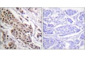 Immunohistochemistry analysis of paraffin-embedded human breast carcinoma, using p53 (Phospho-Ser392) Antibody. (p53 anticorps  (pSer392))