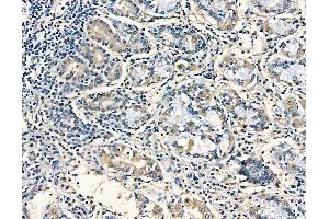 ABIN6257942 and ABIN6275202 at 1/100 staining human pancreatic cancer and adjacent non-tumor tissue by IHC-P. (AASDHPPT anticorps  (C-Term))