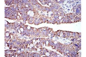 Immunohistochemical analysis of paraffin-embedded rectum cancer tissues using PHB mouse mAb with DAB staining.