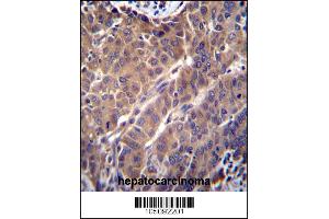 ARL2 Antibody immunohistochemistry analysis in formalin fixed and paraffin embedded human hepatocarcinoma followed by peroxidase conjugation of the secondary antibody and DAB staining. (ARL2 anticorps  (C-Term))