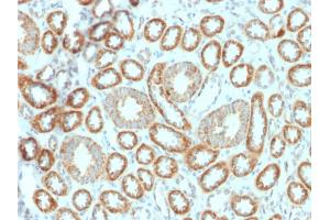 Formalin-fixed, paraffin-embedded human Renal Cell Carcinoma stained with Erythropoietin (EPO) Mouse Monoclonal Antibody (EPO/1367).