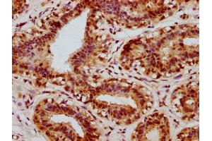 IHC image of ABIN7127685 diluted at 1:100 and staining in paraffin-embedded human breast cancer performed on a Leica BondTM system. (Recombinant CREB1 anticorps  (pSer133))