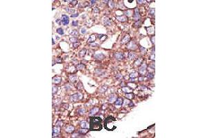 Formalin-fixed and paraffin-embedded human cancer tissue reacted with SYVN1 polyclonal antibody  , which was peroxidase-conjugated to the secondary antibody, followed by DAB staining. (SYVN1 anticorps  (C-Term))