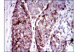 Immunohistochemical analysis of paraffin-embedded esophageal cancer tissues using CK5 mouse mAb with DAB staining.