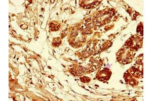 Immunohistochemistry of paraffin-embedded human breast cancer using ABIN7144028 at dilution of 1:100 (Amphiregulin anticorps  (AA 107-148))