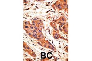 Formalin-fixed and paraffin-embedded human breast cancer tissue reacted with SNAI1 polyclonal antibody  , which was peroxidase-conjugated to the secondary antibody, followed by AEC staining.