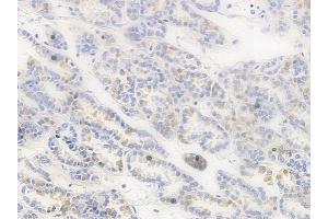 ABIN6255629 and ABIN6267394 at 1/100 staining human renal cell carcinoma by IHC-P. (RPA2 anticorps  (pThr21))