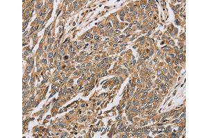 Immunohistochemistry of Human lung cancer using PTGER2 Polyclonal Antibody at dilution of 1:45 (PTGER2 anticorps)