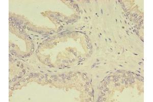 Immunohistochemistry of paraffin-embedded human prostate cancer using ABIN7159642 at dilution of 1:100 (MTHFR anticorps  (AA 1-656))