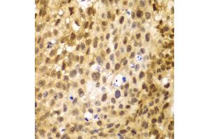 Immunohistochemistry of paraffin-embedded human lung cancer using IRF3 antibody. (IRF3 anticorps)