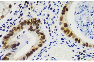Immunohistochemistry of paraffin-embedded Human gastric cancer using RNF2 Polyclonal Antibody at dilution of 1:100 (40x lens).