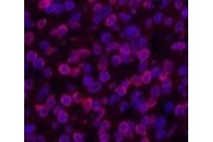 Immunofluorescence analysis of Human lung cancer tissue using Lamin B1 Monoclonal Antibody at dilution of 1:200. (Lamin B1 anticorps)