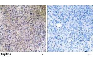 Immunohistochemistry analysis of paraffin-embedded human lung carcinoma tissue using NDUFS7 polyclonal antibody . (NDUFS7 anticorps)
