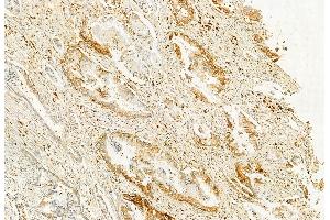 ABIN6262478 and ABIN6272858 at 1/100 staining Human pancreatic cancer by IHC-P. (IFT20 anticorps  (N-Term))