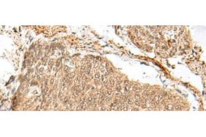 Immunohistochemistry of paraffin-embedded Human esophagus cancer tissue using GEMIN4 Polyclonal Antibody at dilution of 1:30(x200) (GEMIN4 anticorps)