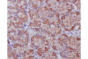 Immunohistochemical analysis of paraffin-embedded human stomach cancer, using EGFR (ErbB 1) Antibody.