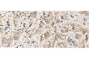 Immunohistochemistry of paraffin-embedded Human liver cancer tissue using CMTM1 Polyclonal Antibody at dilution of 1:40(x200) (CMTM1 anticorps)