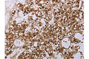 The image is immunohistochemistry of paraffin-embedded human prostate cancer tissue using ABIN7190062(CASP8AP2 Antibody) at dilution 1/20. (FLASH anticorps)