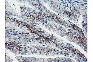 Immunohistochemical staining of paraffin-embedded Adenocarcinoma of Human endometrium tissue using anti-DTNB mouse monoclonal antibody. (Dystrobrevin beta anticorps)