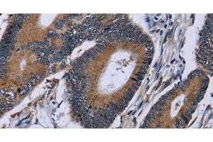Immunohistochemistry of paraffin-embedded Human colon cancer using IPO4 Polyclonal Antibody at dilution of 1:50 (Importin 4 anticorps)