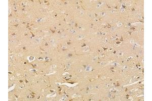 ABIN6265624 and ABIN6266916 at 1/100 staining human glioblastoma by IHC-P. (TNFAIP2 anticorps  (N-Term))